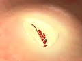 Prolapsed Mitral Valve Repair