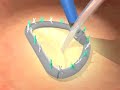 Prolapsed Mitral Valve Repair