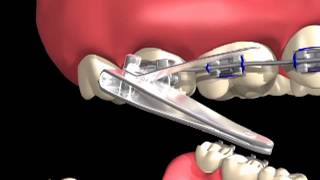 Broken Or Loose Brackets 