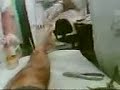 Removal of External Fixation Removal of External Fixation