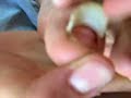 Edwin's Toenail Removal
