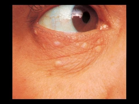 how to treat syringoma