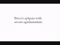 Broca's Aphasia
