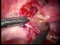 Endometriosis-Perito