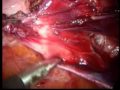 Endometriosis Peritoneal