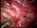 Endometriosis-Perito