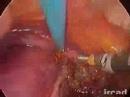 Laparoscopic Collis-Nissen for Shortened Esophagus