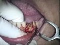 Magyarország, RePlant implantátum műtét 1