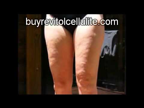 how to cure cellulite