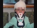 What is morquio Syndrome?