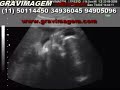 GRAVIMAGEM 38 (ULTRA-SOM DE GRAVIDEZ COM 29 SEMANAS 3D 4D) GRAVIMAGEM 38 (ULTRA-SOM DE GRAVIDEZ COM 29 SEMANAS 3D 4D)