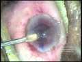 CLEAR CORNEAL CATARACT SURGERY