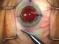 Cataract Surgery-Toric IOL Exchange by re-folding, Pt 2 of 2