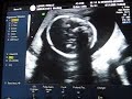 Bébé à 4 mois Bébé à 4 mois
