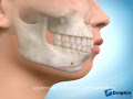 Advancement Genioplasty Surgery
