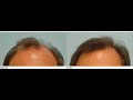 Hair transplant: how to create a natural hairline