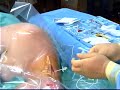 Continuous Cervical Paravertebral Block Continuous Cervical Paravertebral Block