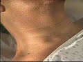 Examination of the Neck Vessels Examination of the Neck Vessels