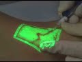 Sclerotherapy with the Vein Viewer Sclerotherapy with the Vein Viewer