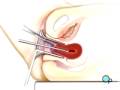 PreOp® Patient Ed Dilation and Curettage Surgery