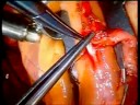 beating heart surgery Side to side IMA to LAD
