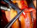 beating heart surgery Side to side IMA to LAD