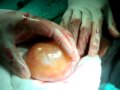 &HAIR Removal Live From Operation Theatre!!!
