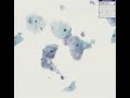 Histopathology Cervix--Bacterial vaginosis