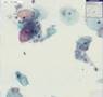 Histopathology Cervix--Bacterial vaginosis