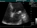 Mitral And Aortic Stenosis In Echo Examination