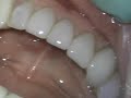 veneer removal.avi