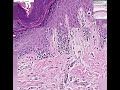 Histopathology Skin--Melanoma in situ Histopathology Skin--Melanoma in situ