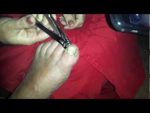 how to clamp off ng tube
