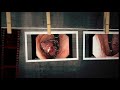 Gastric Cancer Photo Gallery