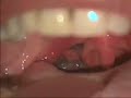 Melanoma en am�gdala derecha
