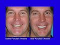 Case studies using Porcelain Veneers