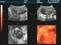 16-17 weeks pregnant ultrasound-Is it a boy or a girl?