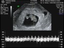 9 week ultrasound
