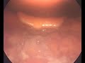 patekei - thick phlegm - tiny polyp - high risk of hemorrhage.mp4