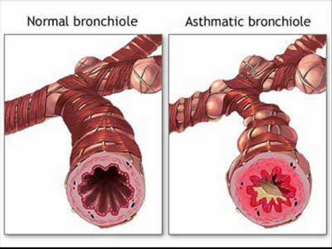 FASTING AND ASTHMA , HEALTH EDUCATION , INFECTION CONTROL (ICSP) , URDU / HINDI .