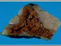 Adrenal Glands