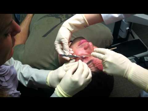 Chalazion repair