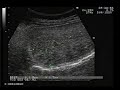 Hemangioma