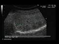 Hemangioma