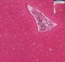Histopathology Brain--Paresis (syphilis)