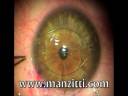 Lente Intraocular para Operacion de Miopia