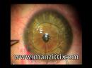 Lente Intraocular para Operacion de Miopia