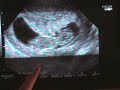 Baby Kimel at 11 Weeks and 1 Day