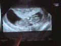 Baby Kimel at 11 Weeks and 1 Day