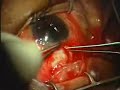 Ahmed Valve Surgery for Glaucoma PART3